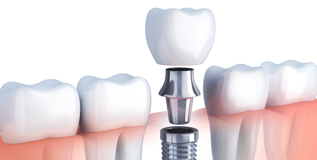 Why to choose Dental Implants other than Dental Prosthetics