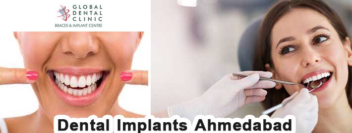 dental implants ahmedabad-1